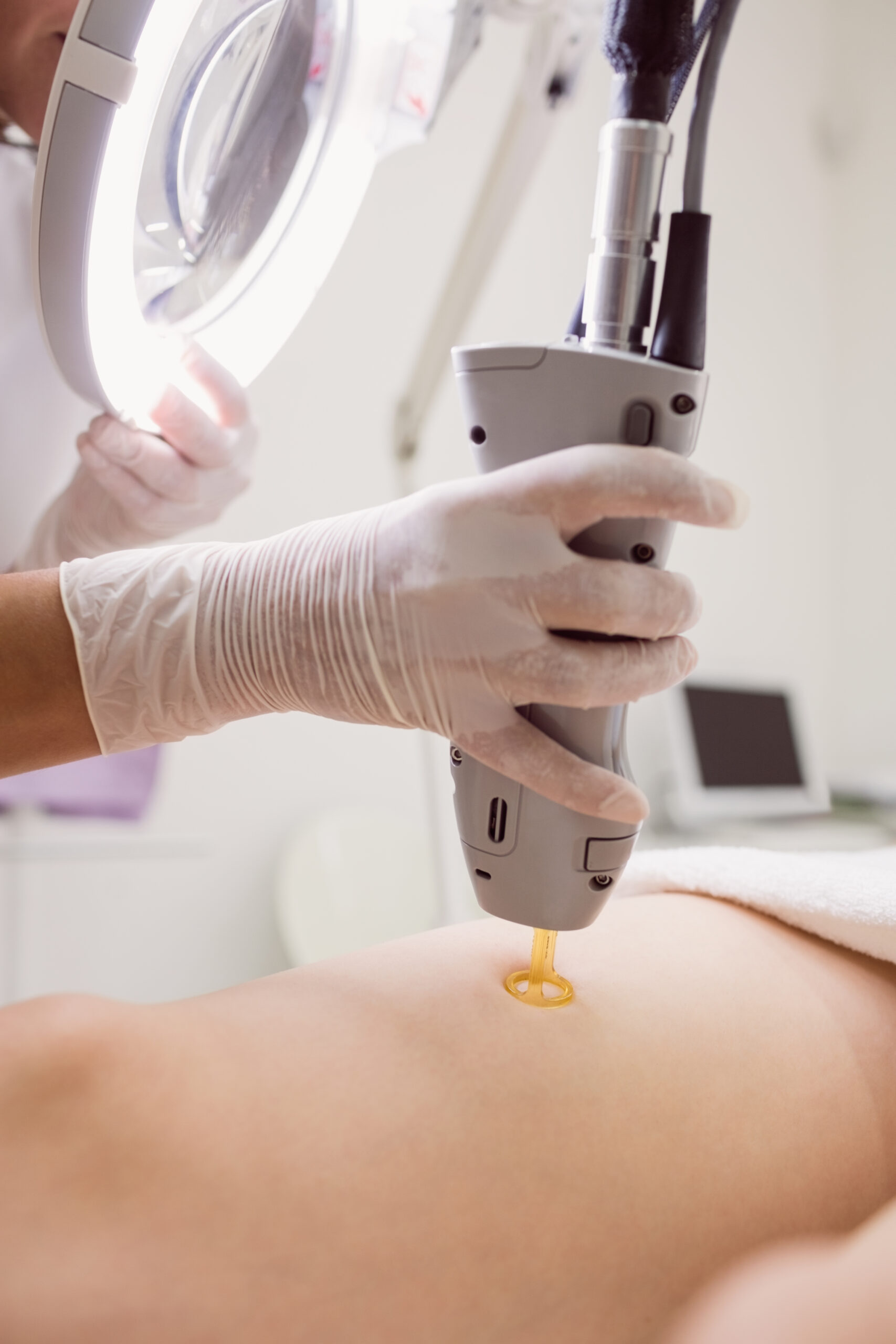 Close up of doctor performing laser hair removal on female patient skin in clinic